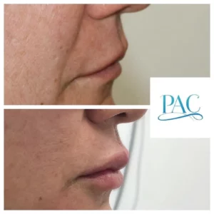 Natural Lip Filler Enhancement