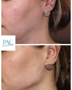 Jawline Augmentation Filler