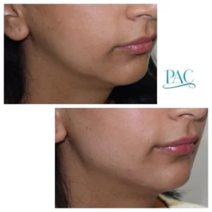 Jawline Filler