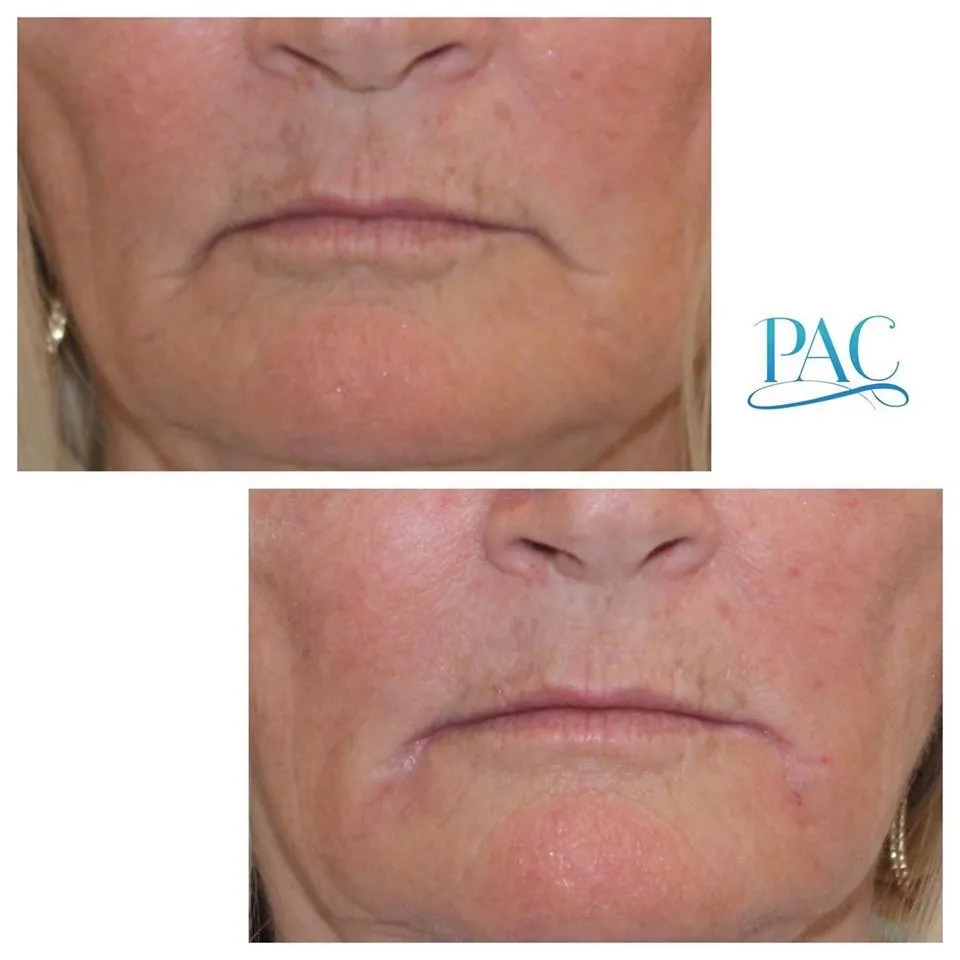 Perioral Wrinkle Reduction