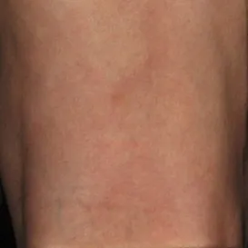 Varicose+Vein+Sclerotherapy+Asclera+Example-1920w
