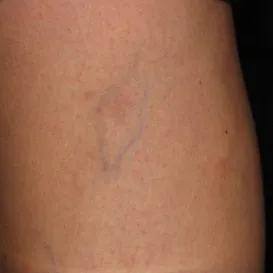 Varicose+Veins+Sclerotherapy-1920w