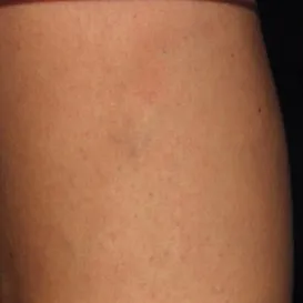 Varicose+Veins+Sclerotherapy+Asclera-1920w