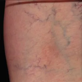 Varicose+and+Spider+Veins+Sclerotherapy+Example-1920w