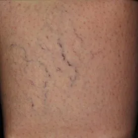 spider+veins+sclerotherapy-1920w