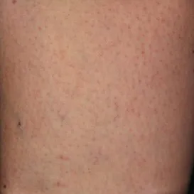 spider+veins+sclerotherapy+asclera-1920w