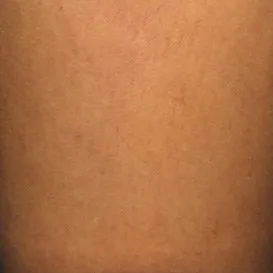 spider+veins+sclerotherapy+asclera+example-1920w