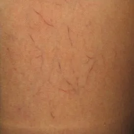 spider+veins+sclerotherapy+example-1920w