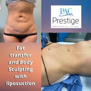 Sculpting Liposuction and Fat transfer