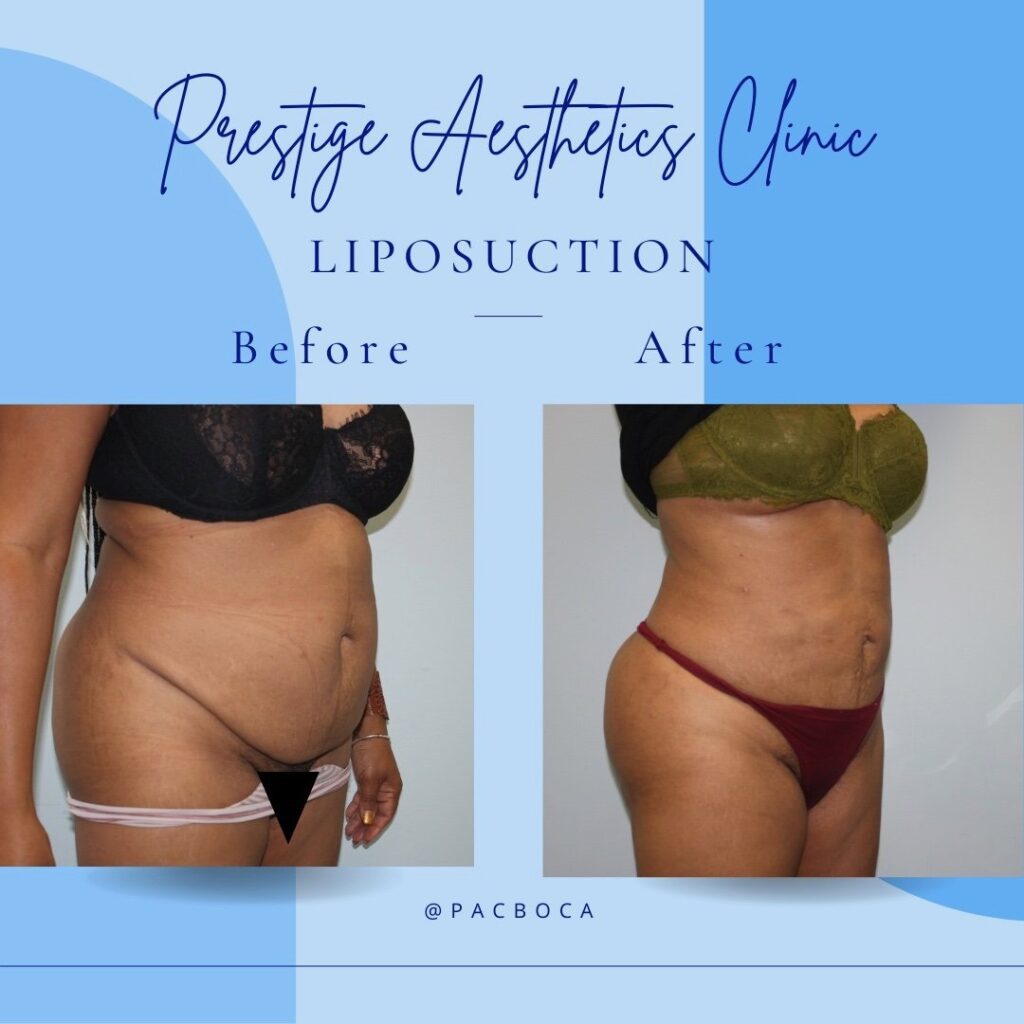 Liposuction in Boca Raton: #1 Guide to Body Contouring at Prestige Aesthetics Clinic 1 Non Surgical Liposuction and Body Sculpting in Boca Raton