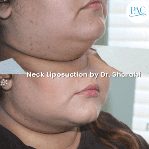 Liposuction of the Neck Great Results
