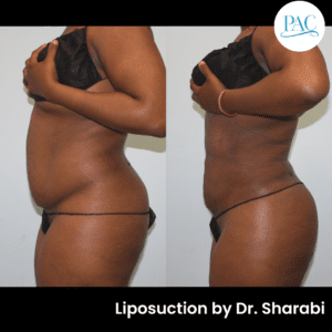 Liposuction Side View Belly