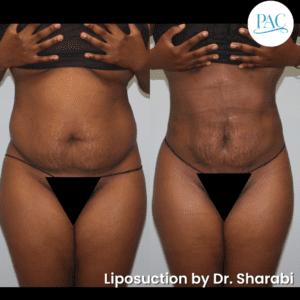 Liposuction Abdomin