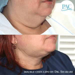 Neck Liposuction Amazing Results