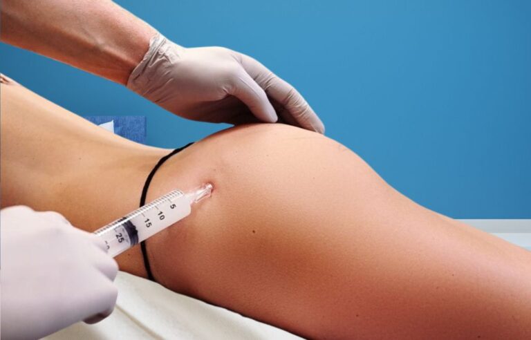 Enhancing Your Curves: The Benefits of Hyperdilute Radiesse for Buttocks Volume Enhancement 1 Hyperdilute Radiesse